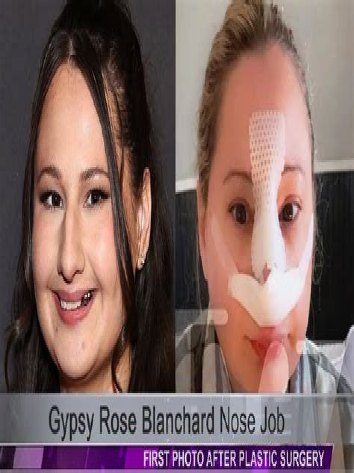 Unveiling The Transformation: The Nose Job Of Gypsy Rose